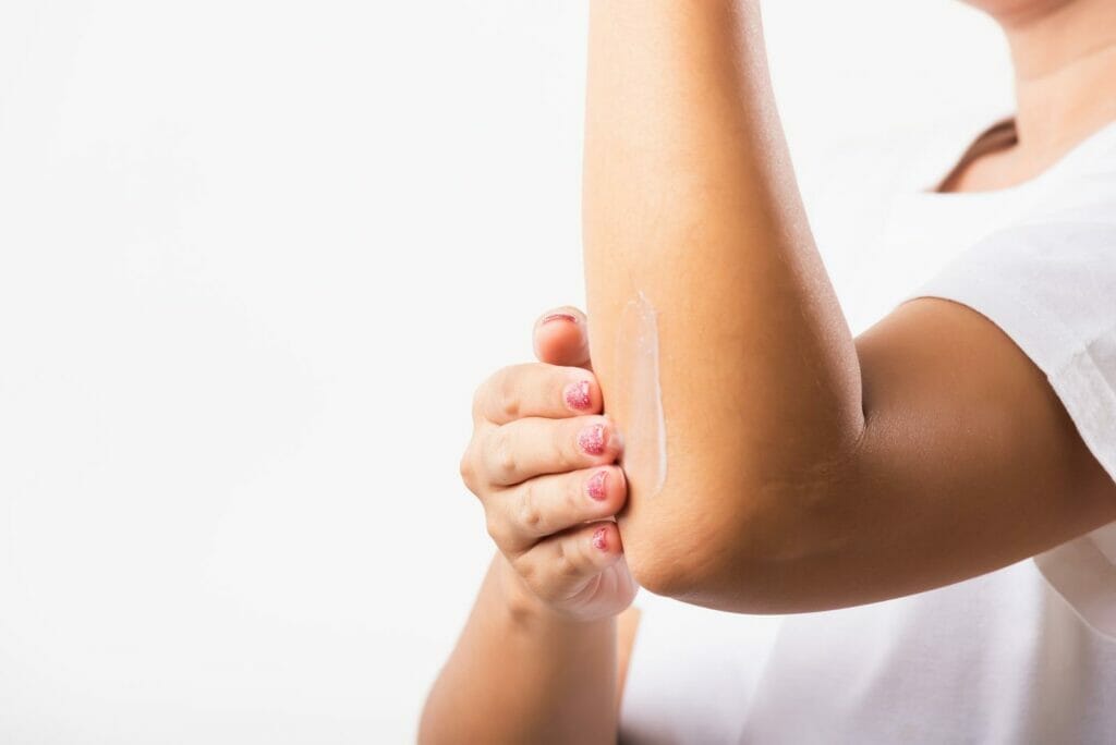 47153402 woman applies lotion cream on her elbow